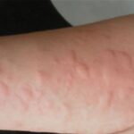 How did rural people treat urticaria in the past?