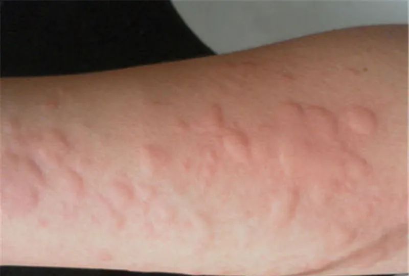 How did rural people treat urticaria in the past?